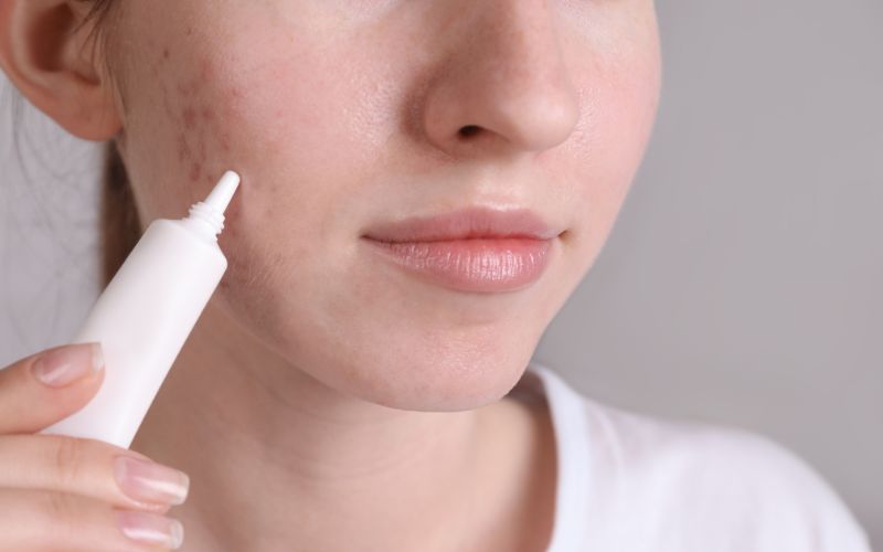 Benzoyl peroxide trong sản phẩm trị mụn có thể ảnh hưởng tiêu cực đến thai nhi