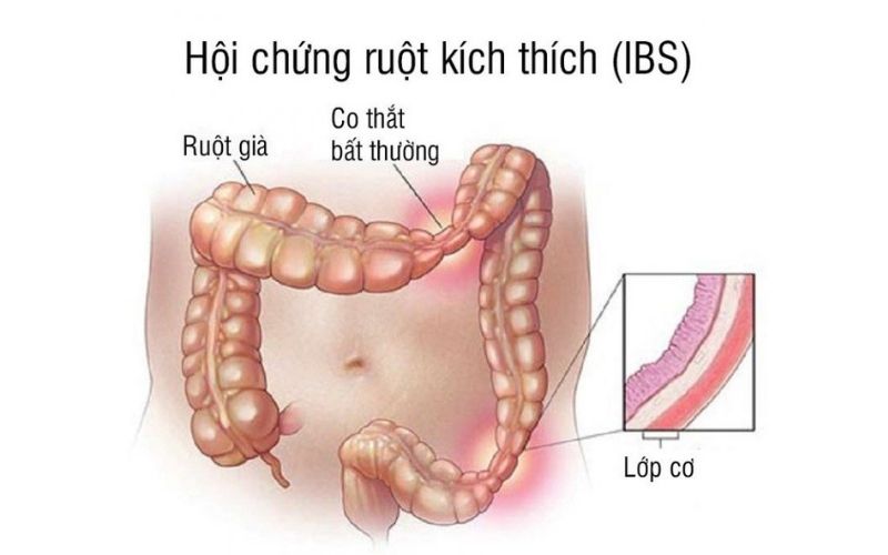 Hội chứng ruột kích thích nổi đau dai dẵn