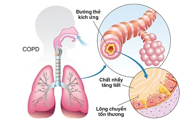 Những nguyên nhân gây ra bệnh thở nông hiện nay