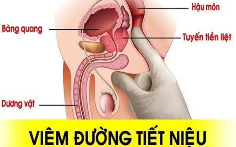 Viêm nhiễm trùng đường tiết niệu ở nam gây vùng chậu