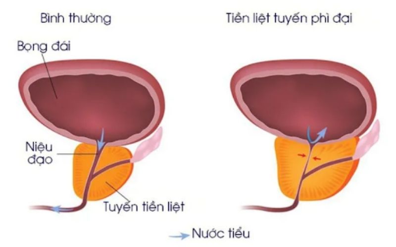 Tăng sản tuyến tiền liệt nguyên nhân gây đau vùng chậu ở nam giới