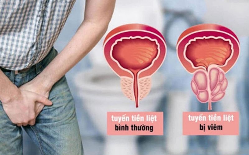 Viêm tuyến tiền tác động lớn đến đau vùng chậu ở nam giới